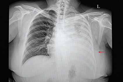 ICI治疗NSCLC 胸腔积液提示免疫治疗结局更差